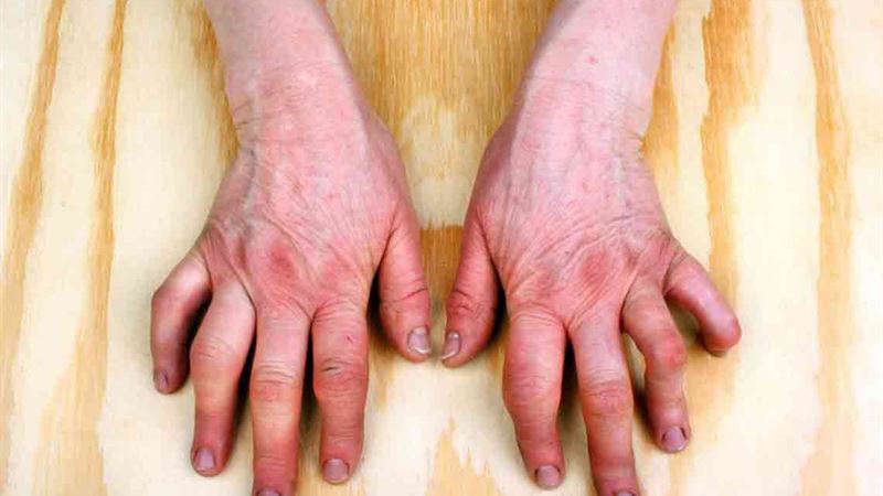 Comprehensive Guide to Recognizing Rheumatoid Arthritis Symptoms and Management Strategies