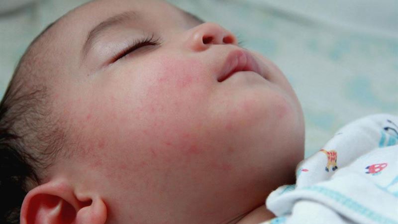Comprehensive Guide to Recognizing and Managing Infant Eczema Symptoms