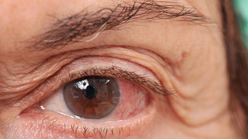 Comprehensive Strategies for Managing Persistent Dry Eye Syndrome
