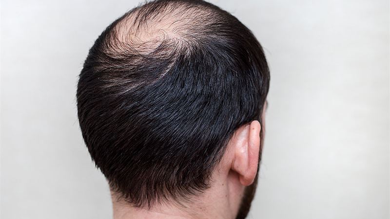 Understanding Male Hair Loss: Causes, Stages, and Prevention Strategies