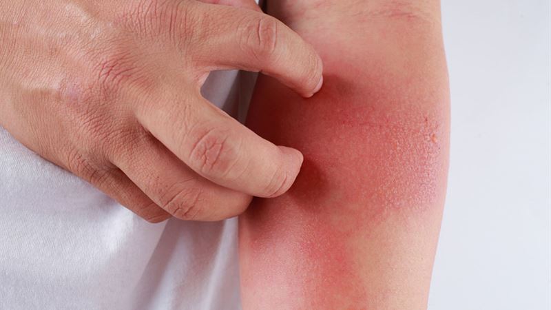 Comprehensive Guide to Recognizing and Managing Skin Rashes