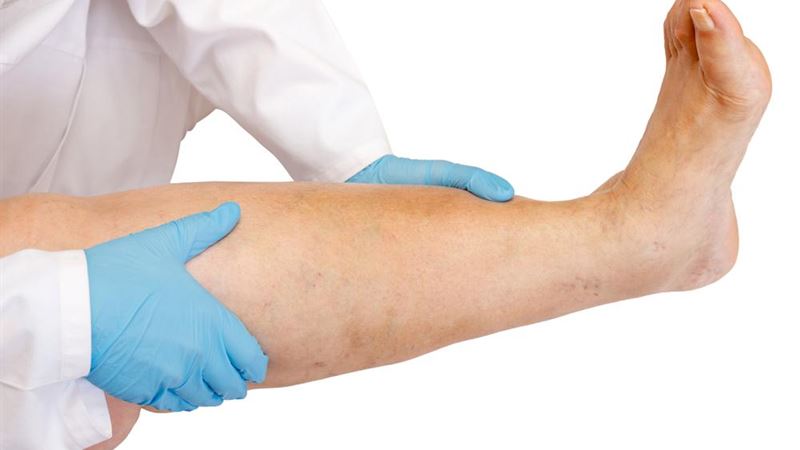 Comprehensive Guide to Deep Vein Thrombosis: Symptoms, Diagnosis, and Effective Treatments