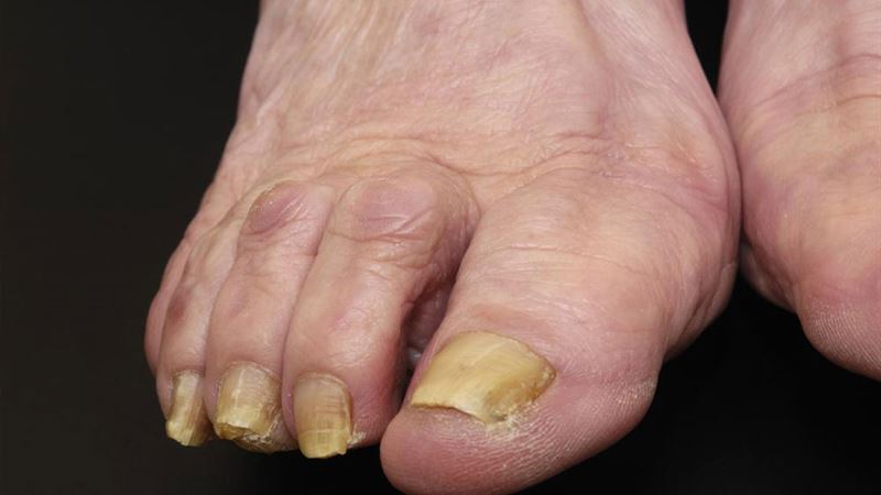 Effective Natural Remedies for Treating Nail Fungus: A Comprehensive Guide