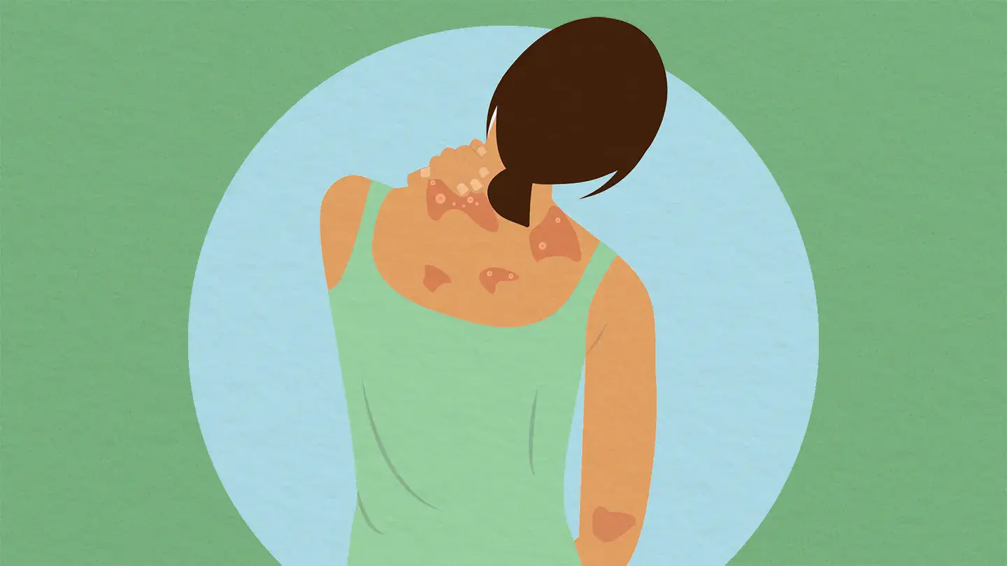 Comprehensive Guide to Plaque Psoriasis: Symptoms, Causes, and Effective Management Strategies