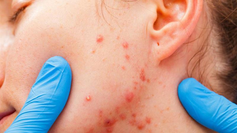 Comprehensive Guide to Myeloma: Types, Stages, and Key Insights