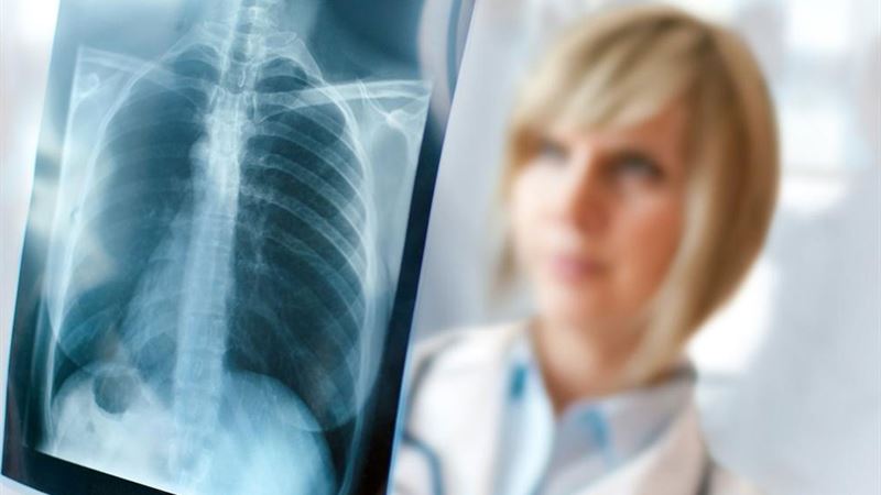 Comprehensive Guide to Lung Cancer Staging: Understanding the Key Stages and Their Implications