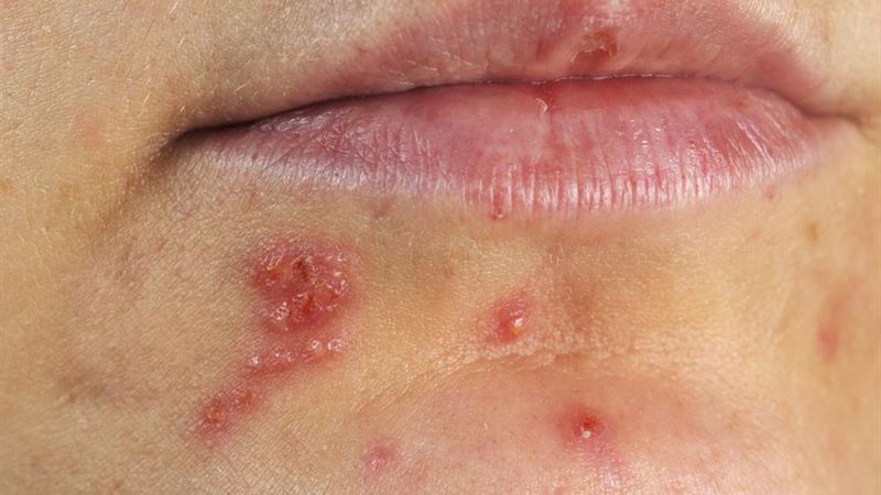 Comprehensive Dietary Strategies for Managing Herpes Outbreaks