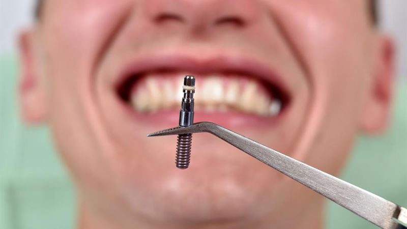 Comprehensive Guide to Understanding Dental Implants Pricing and Costs