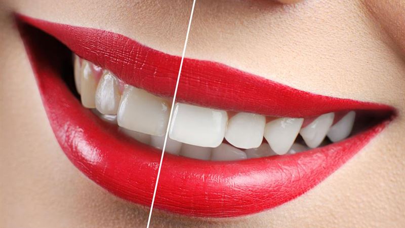 Effective Strategies to Prevent Teeth Discoloration and Maintain a Bright Smile