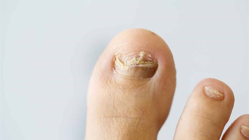 Effective Strategies for Treating Nail Fungal Infections