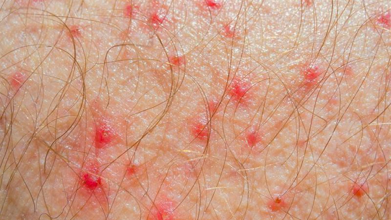 Comprehensive Guide to Understanding and Managing Atopic Dermatitis
