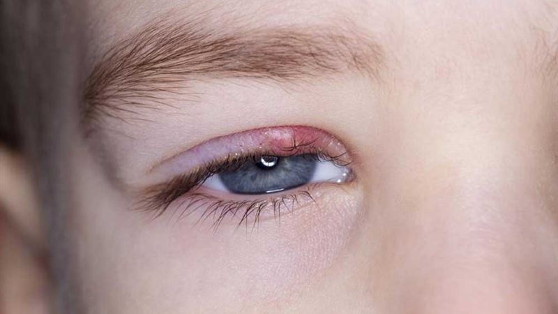 Comprehensive Guide to Recognizing and Understanding Eyelid Inflammation Symptoms and Causes