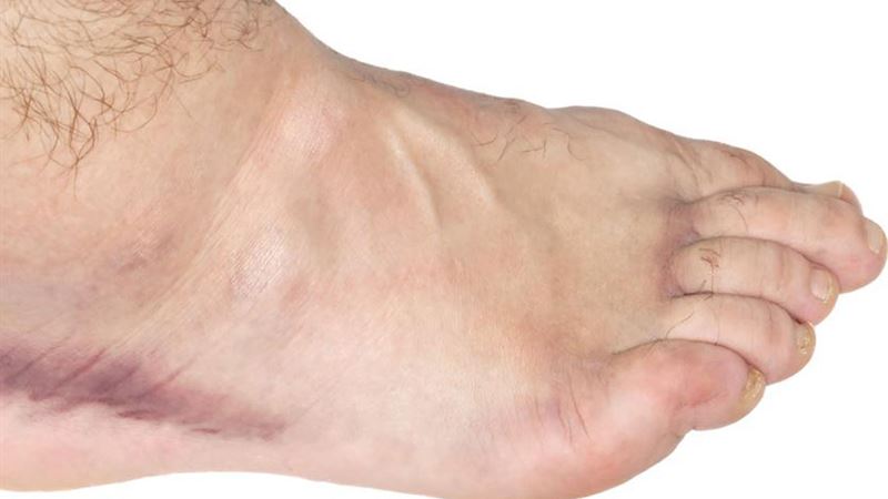 Comprehensive Guide to Alleviating Swollen Ankle Discomfort