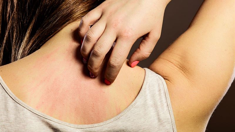 Comprehensive Strategies for Managing Post-Shingles Discomfort