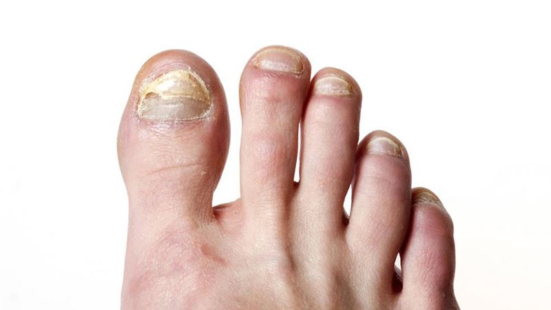 Identifiable Symptoms of Toe Nail Fungal Infections and Their Detection