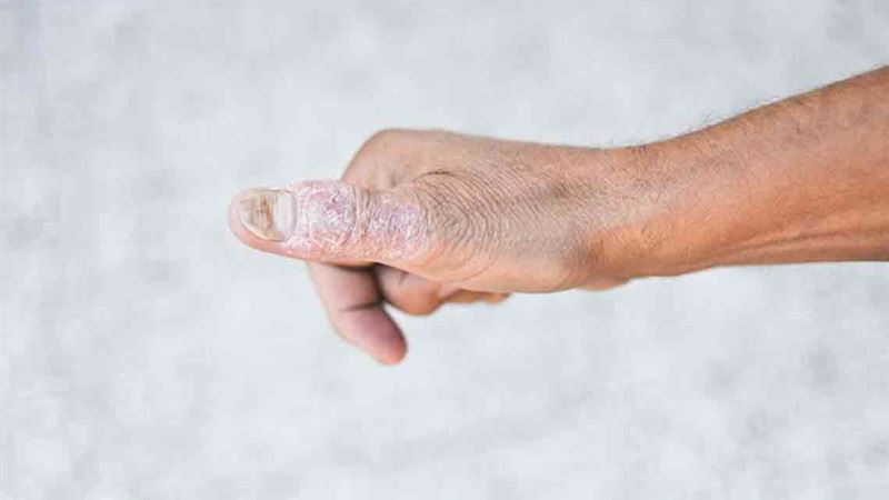 Comprehensive Natural Approaches to Managing Lupus-Related Skin Rash