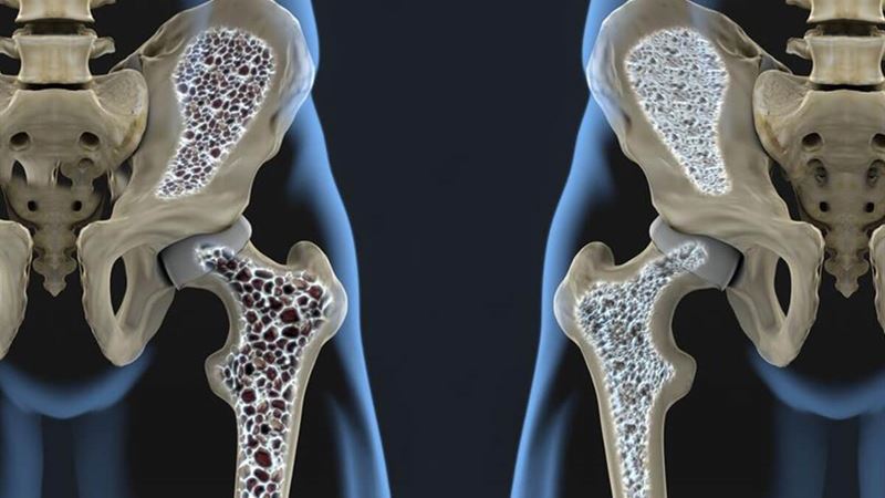 Understanding Medical Conditions That Contribute to Osteoporosis-Related Bone Erosion