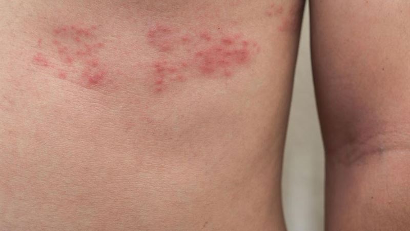 Comprehensive Guide to Effective and Simple Shingles Treatments