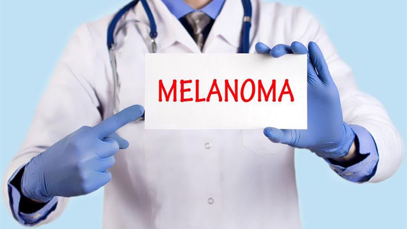 Comprehensive Overview of Diagnosis and Innovative Treatments for Advanced Melanoma
