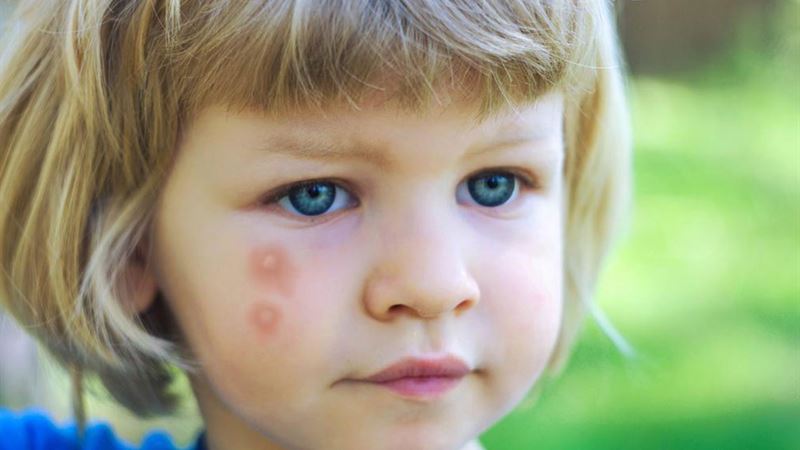 Comprehensive Guide to Recognizing and Differentiating Insect Bites