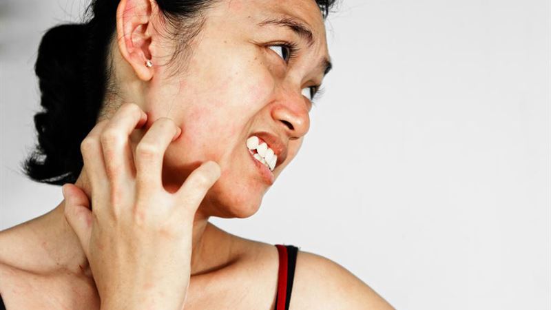 Comprehensive Guide to Managing and Treating Rosacea Effectively