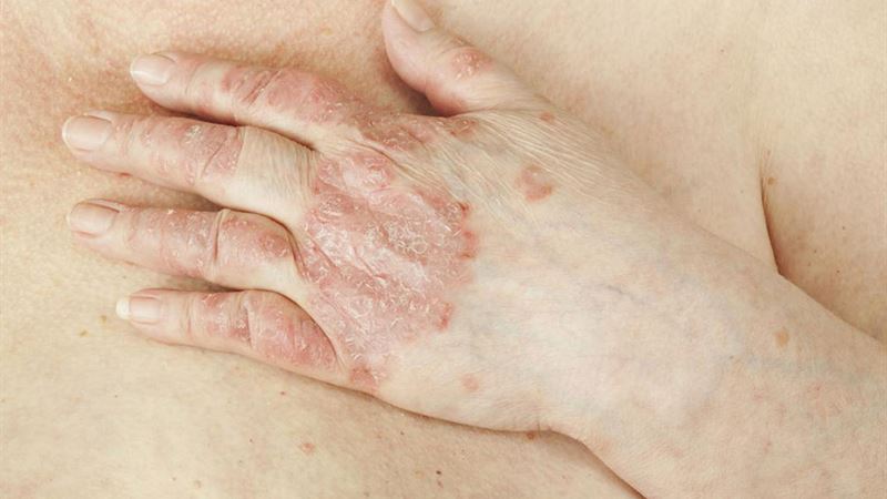 Comprehensive Guide to Managing Psoriatic Arthritis and Its Most Effective Treatment Strategies