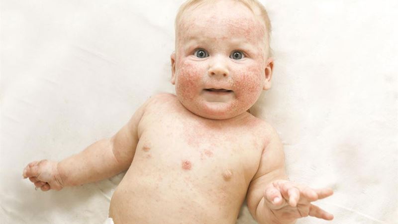 Comprehensive Guide to Effective Treatments for Atopic Dermatitis