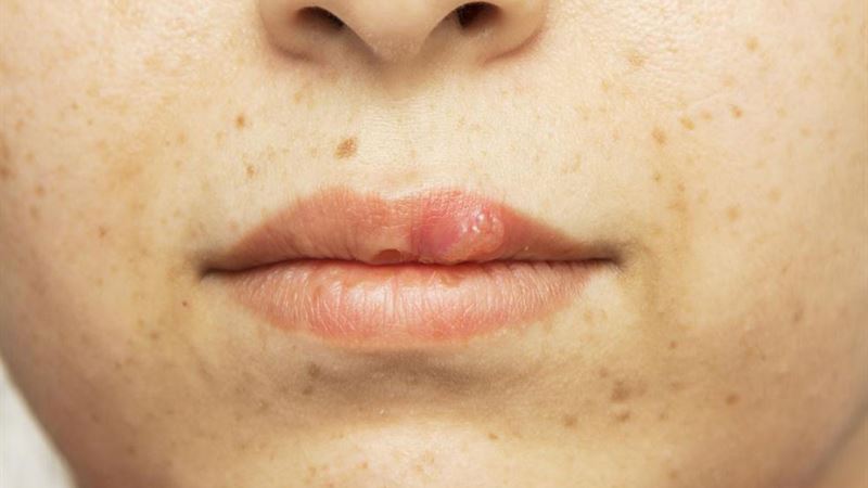 Effective Home Remedies for Accelerated Blister Healing