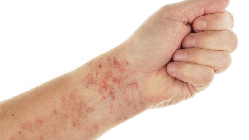 Understanding Multiple Myeloma: Causes, Symptoms, and Treatments for Better Health