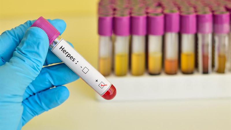 Effective Strategies to Manage and Reduce Herpes Virus Infections