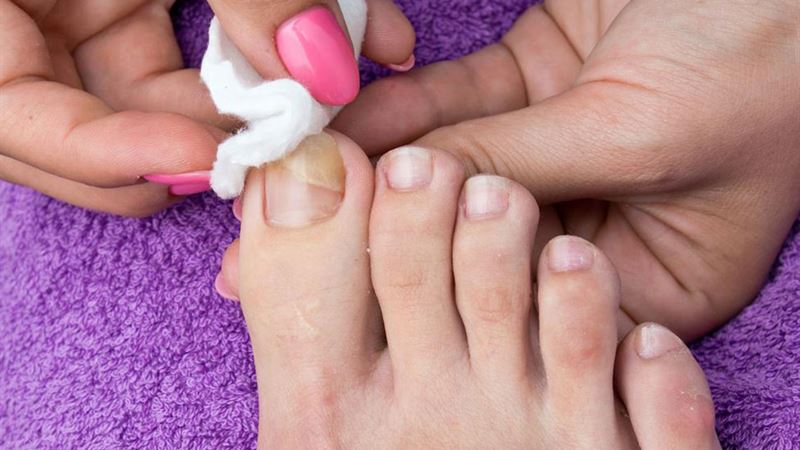 Comprehensive Guide to the Best 5 Treatments for Nail Fungus Infections