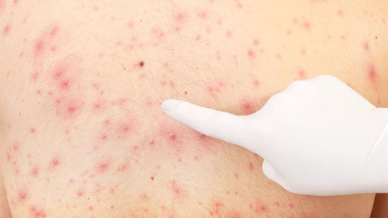Effective Home Remedies for Managing Keratosis Pilaris