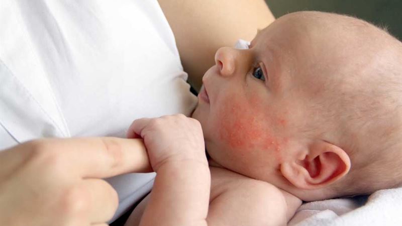 Comprehensive Guide to Managing and Treating Scabies Skin Rash