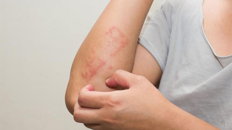 Comprehensive Guide to Understanding Scabies and Its Skin Manifestations