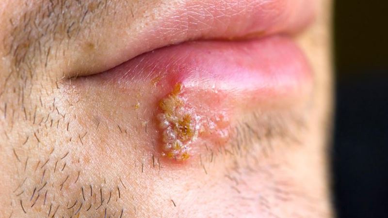 Effective Natural Strategies to Eliminate Cold Sores Quickly