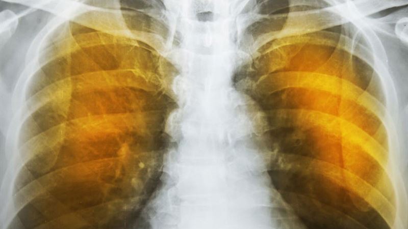 Understanding Emphysema: Causes, Symptoms, and Potential Complications