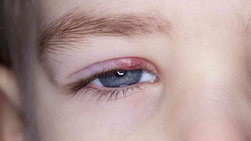 Comprehensive Guide to Effectively Eliminating Styes Naturally
