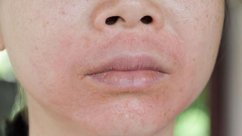 Effective Strategies for Managing Skin Rashes Caused by Insect Bites