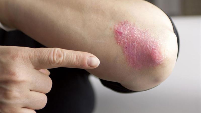 Comprehensive Guide to Chronic Psoriasis: Types, Symptoms, and Effective Treatments