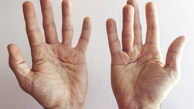Comprehensive Guide to Recognizing and Managing Dupuytren’s Contracture
