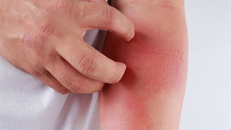 Effective Dietary Strategies to Manage Eczema Symptoms and Improve Skin Health