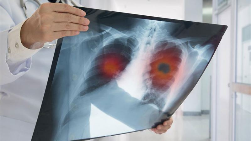 Comprehensive Guide to Non-Small Cell Lung Cancer: Symptoms, Diagnosis, and Treatment Options