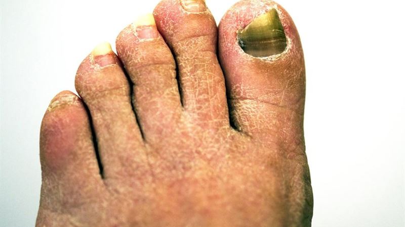 Effective Strategies to Eliminate Toenail Fungus and Restore Nail Health