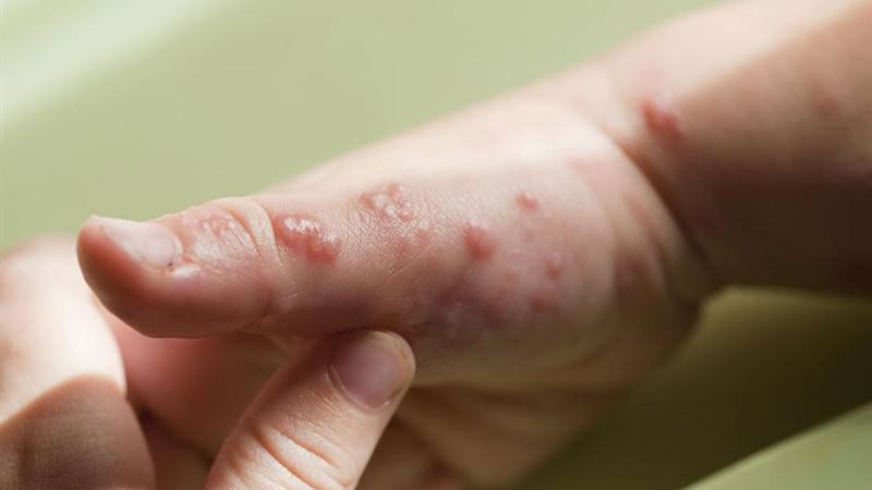 Comprehensive Guide to Managing and Treating Viral Infection Symptoms