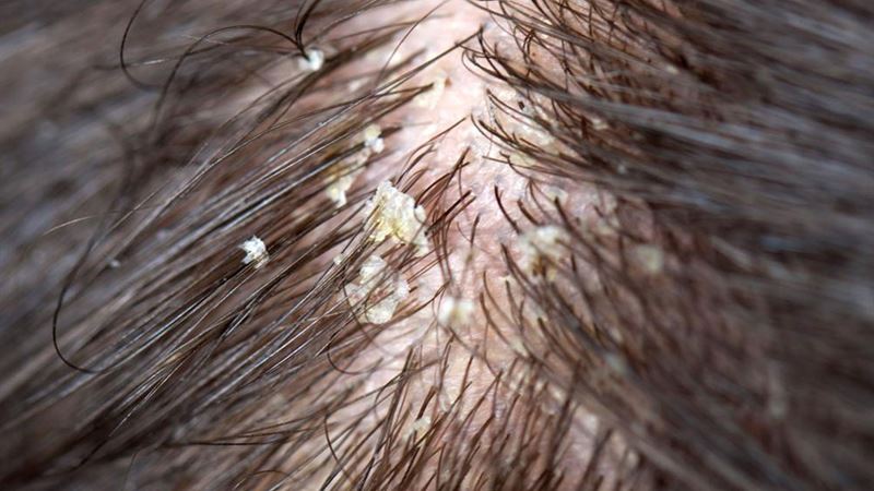 Effective Natural Remedies to Combat Dry Scalp and Restore Hair Health