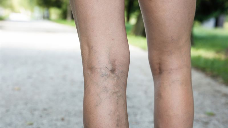 Comprehensive Guide to Spider Vein Removal: Effective Treatments for Achieving Smooth, Clear Skin