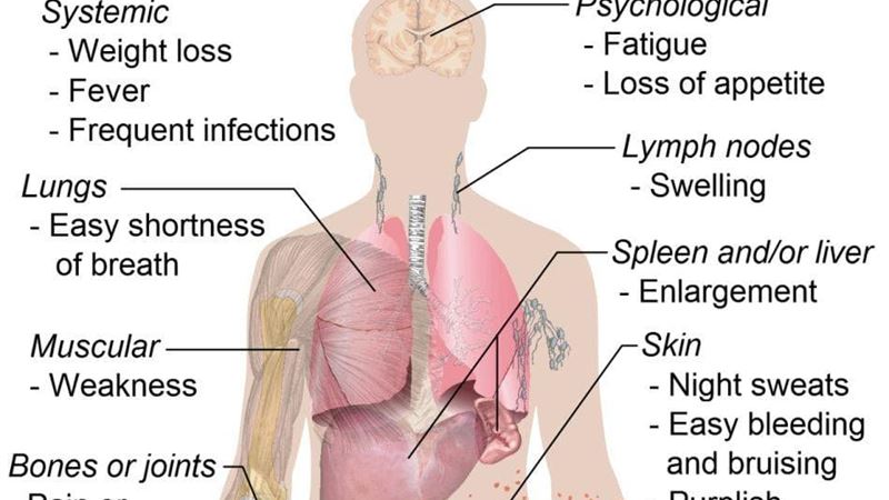 Recognizing Hidden Signs of Leukemia: A Comprehensive Guide to Symptoms and Early Detection