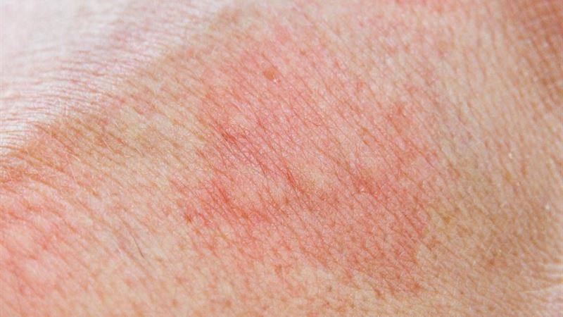 Comprehensive Overview of the Top 5 Skin Rashes and Their Causes