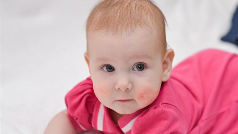 Comprehensive Guide to Managing and Understanding Eczema: Causes, Symptoms, and Treatments