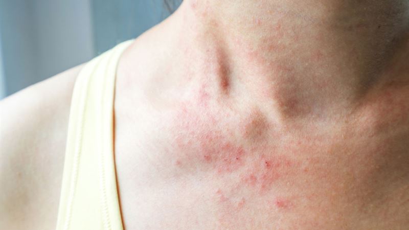 Understanding Mycosis Fungoides: Beyond a Skin Rash